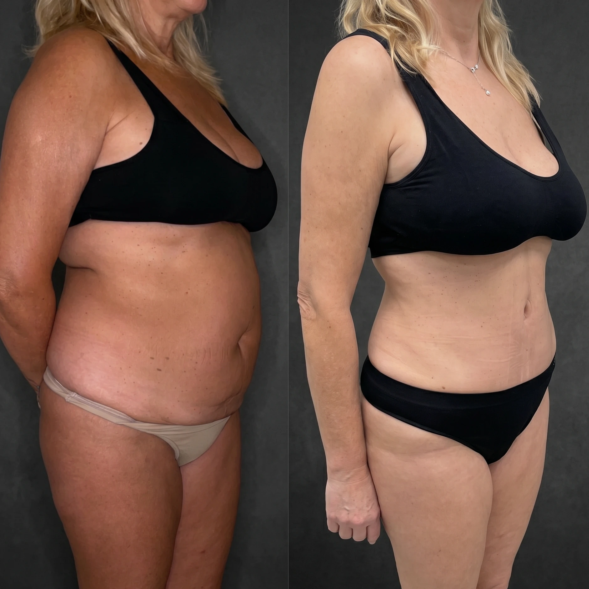 Resultado Mela Lasser: Abdomen y cintura