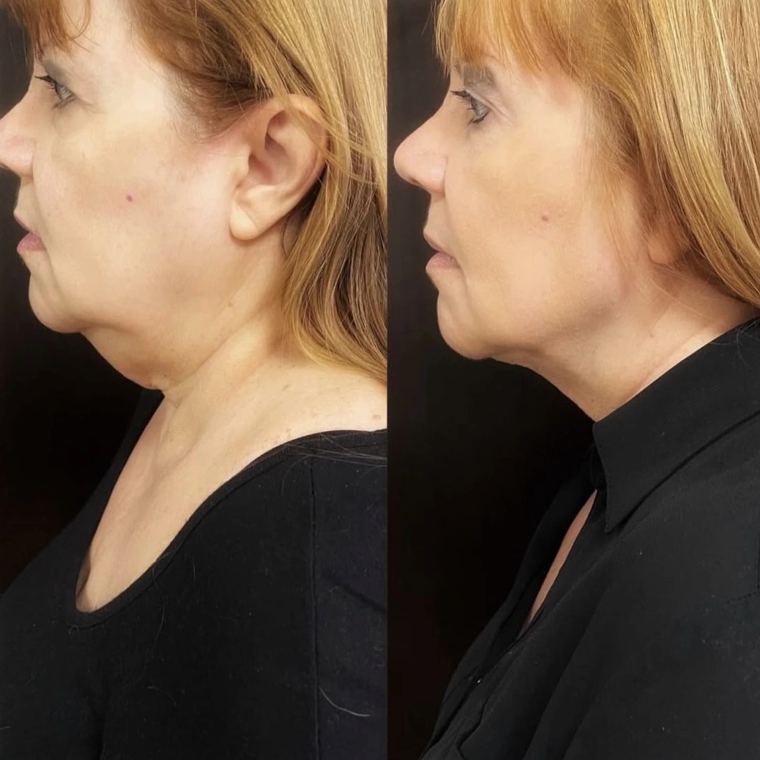 Resultado Mela Lasser: Abdomen y cintura