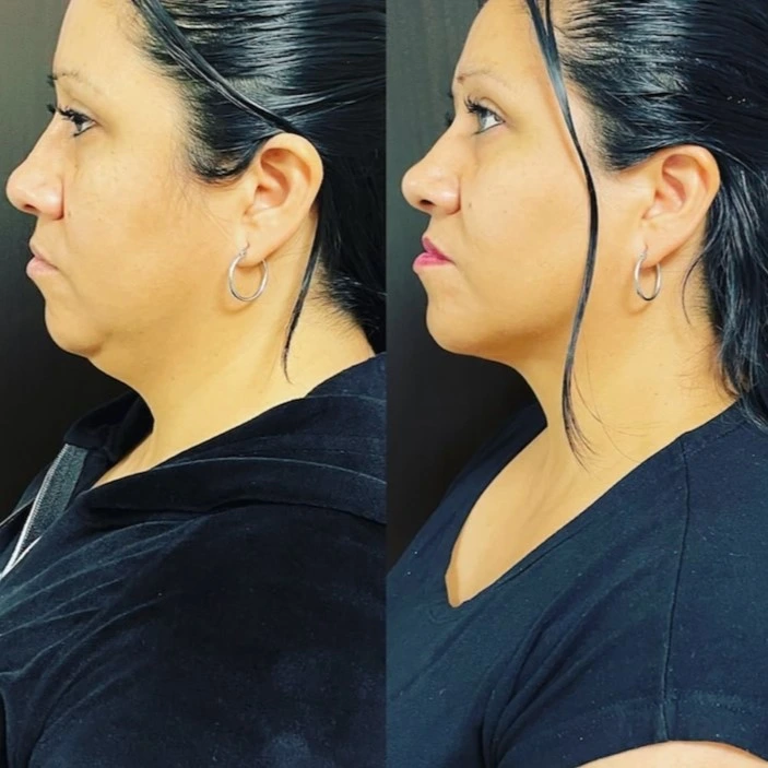 Resultado Mela Lasser: Abdomen y cintura
