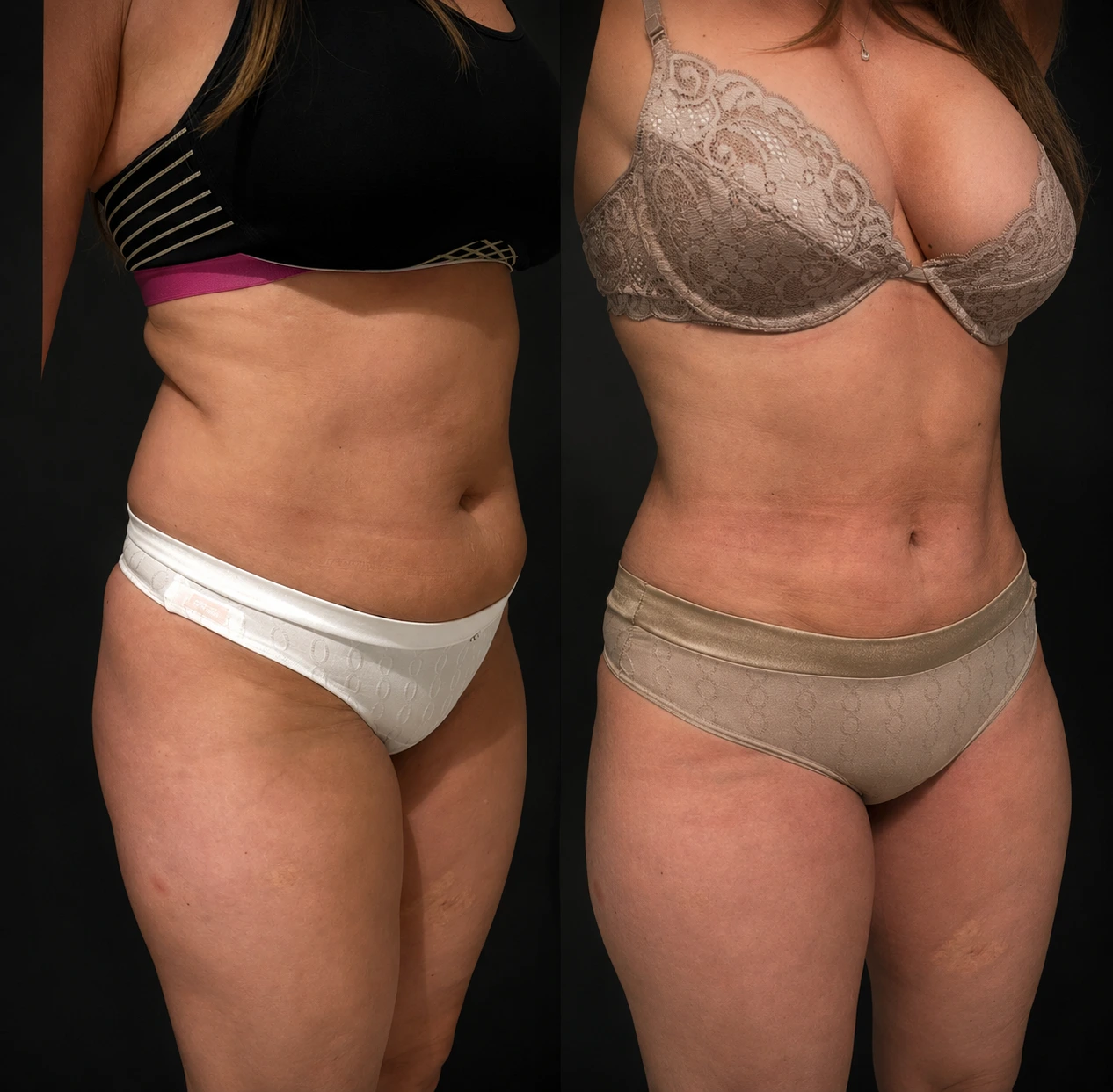 Resultado Mela Lasser: Abdomen y cintura