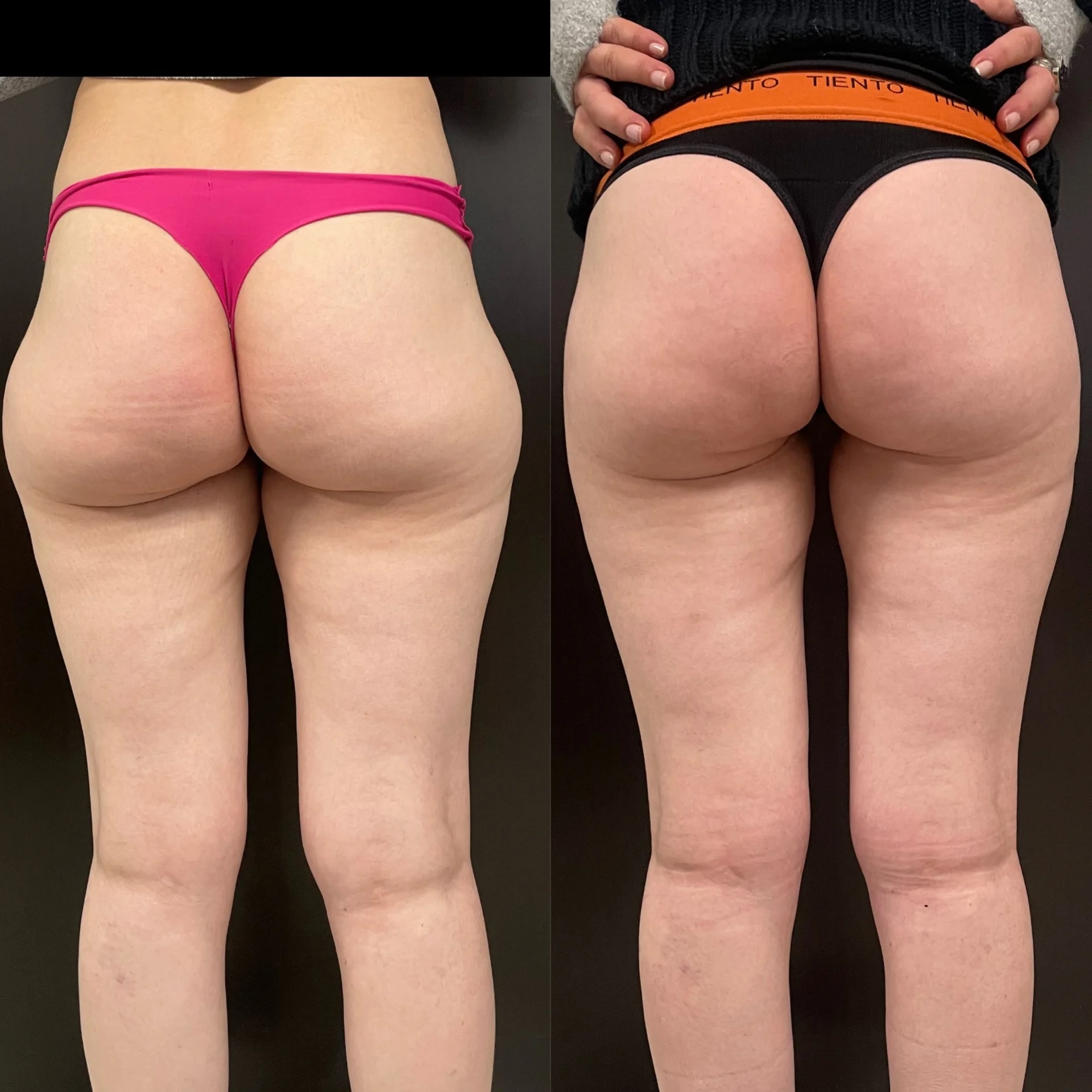 Resultado Mela Lasser: Abdomen y cintura